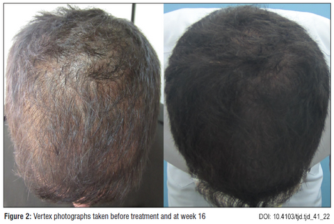 Before and after photos showing significant increase in hair density and thickness in a male patient after 16 weeks of topical procyanidin B2 treatment.