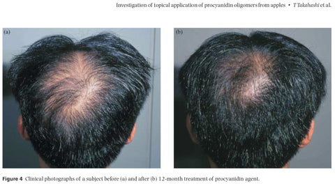 Procyanidin oligomers from apples promote hair growth in this double-blind, placebo controlled clinical trial. Apple procyanidin therapy compared favorably with both minoxidil and finasteride therapy.