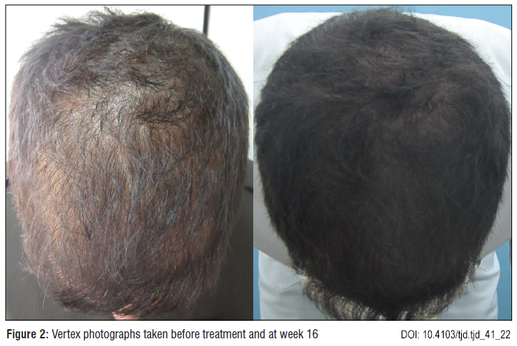 Before and after photos showing significant increase in hair density and thickness in a male patient after 16 weeks of topical procyanidin B2 treatment.