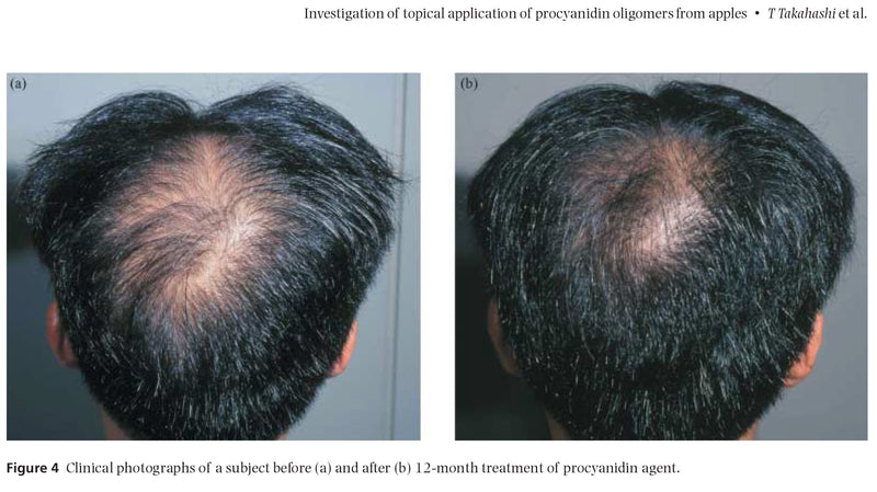 Procyanidin oligomers from apples promote hair growth in this double-blind, placebo controlled clinical trial. Apple procyanidin therapy compared favorably with both minoxidil and finasteride therapy.